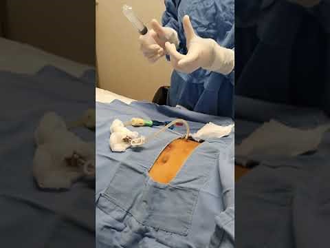 Disfunción de cateter de tenkchoff. Maniobras de repermeabilización. Diálisis peritoneal 👩‍⚕️🩺