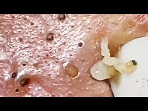 Deep blackhead extraction Cystic acne & pimple popping #45