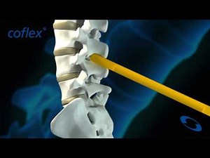 coflex® Procedural Video - YouTube
