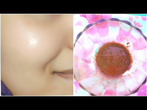 How To Remove Acne/ Pimples Overnight (100% Works) |5 Home Remedies !! Acne Scar Treatment