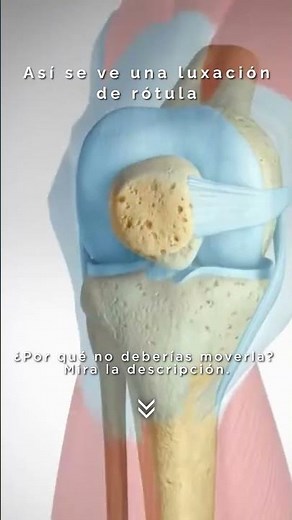#LuxaciónDeRótula #Rodilla #LesionesDeRodilla #Traumatología #Ortopedia #LuxaciónDeRótula #Rodilla