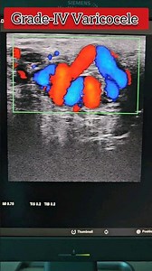 Varicocele on Doppler Ultrasound | Grade -IV dilated vesels on rest #medical #radiology #ultrasound