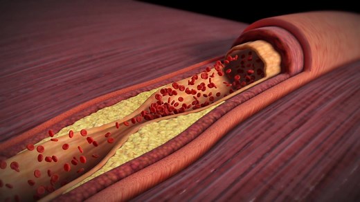 Causes of a Heart Attack