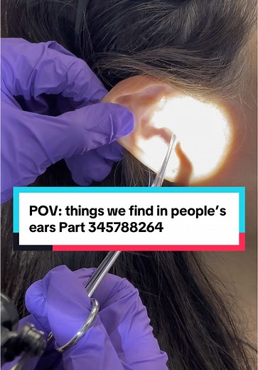 Understanding Earwax Removal and Q-tip Risks