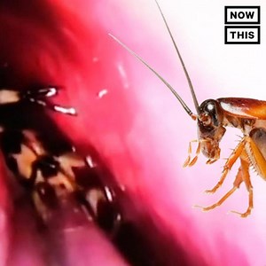 This woman had a live roach crawling around in her skull (warning: gross) | NowThis