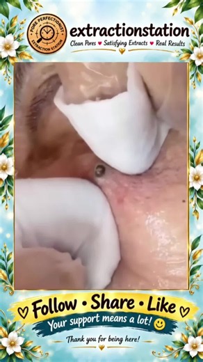 Deep Blackhead Extraction & Satisfying Popping | Wait for the most satisfying pop 😳🫣 You won’t believe what comes out! #pimplepoppersatisfying #Acne #pimple #Blackhead #Satisfying