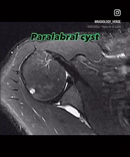 Paralabral Cyst of Shoulder Joint | MRI Findings Explained#MSKRadiology #ParalabralCyst #ShoulderMRI