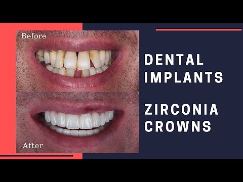 Dental Implants & Zirconia Crowns Patient Review