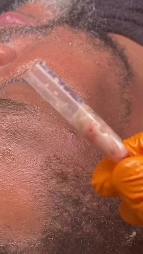 Facial Vacuuming vs Derma Planning For Dead Skin Removal. Book Me Today! #estheticiantiktok #SkincareEducation #fypシ #HappyClients #LosAngelesEsthetician