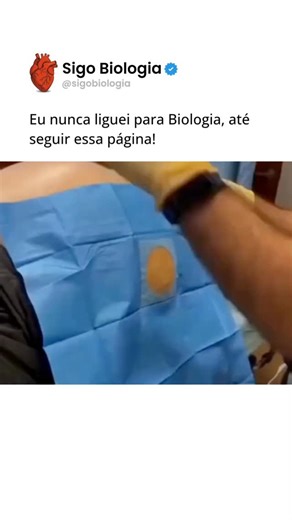 Sigo Biologia | A paracentese é um procedimento médico utilizado para retirar o excesso de líquido que se acumula na cavidade abdominal, conhecido como... | Instagram
