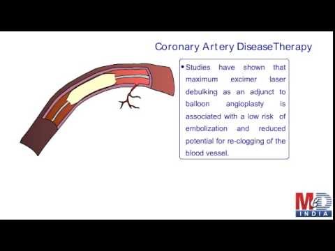Health Animation - Angioplasty - Excimer Laser