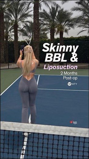 does skinny bbl actually work #beforeandafter #bbl #truthaboutsurgery