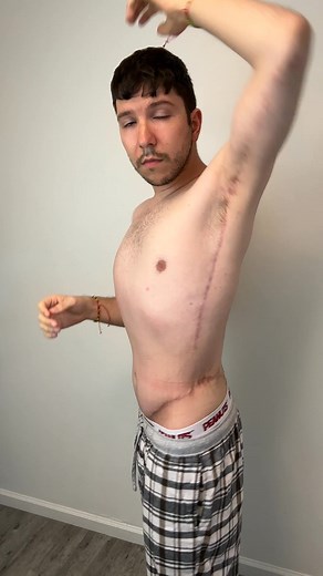 164K views · 399 reactions | Would you rather have a LOOSE skin or SCARS like this? | Nikocado Avocado | Facebook