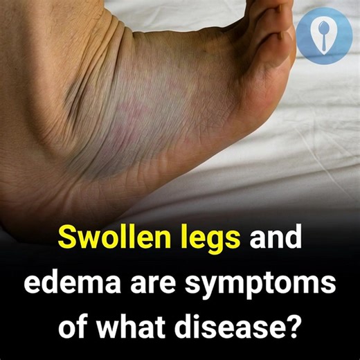 Which medical conditions are linked to leg swelling and edema? | Soulful Stories