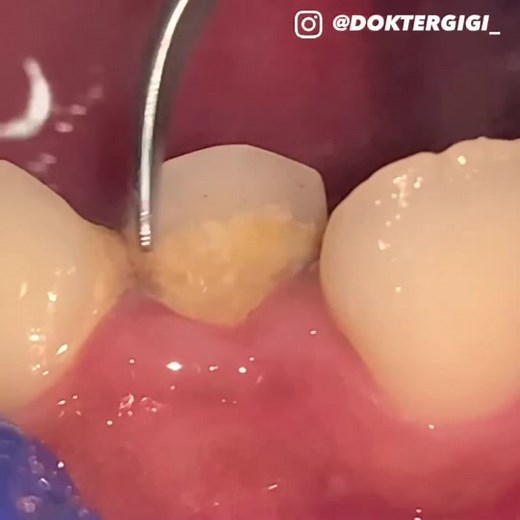 Dental Procedure for Decayed Molar Tooth Removal