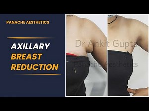 Axillary Breast Reduction Surgery - How they Occur, Types, Benefits, Procedure and Need of Surgery!