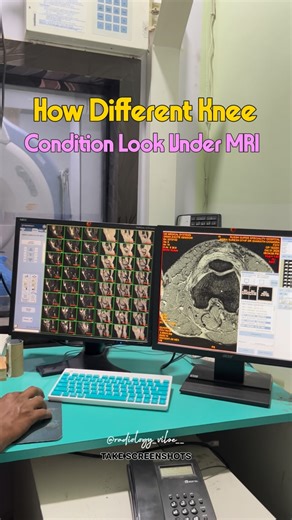 Radiology Vibes on Instagram: "How Different look MRI knee💀💀 1️⃣ ACL Tearbone • MRI: Discontinuity or wavy appearance of ACL fibers, bone bruise on lateral femoral condyle • Cause: Twisting injury, sudden deceleration, or pivot movement 2️⃣ Meniscal Tear • MRI: Bright line or gap across the dark triangular meniscus (horizontal/vertical tear) • Cause: Deep squatting, twisting, or sports-related injuries 3️⃣ Osteochondritis Dissecans (OCD) • MRI: Localized defect in subchondral bone with possibl