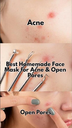 10-Minute Acne & Pores Treatment | Easy Homemade Multani Mitti Mask | Anti-Acne Mask for Clear Skin