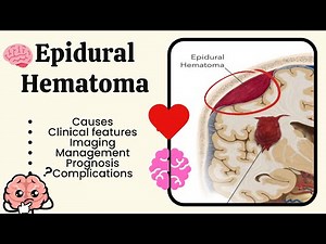 Epidural Hematoma | Brain Injury