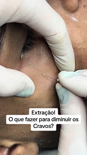 Limpeza de Pele Profunda e Controle de Cravos