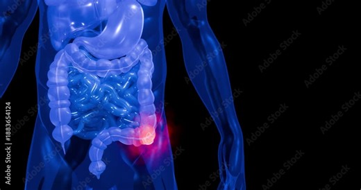 Colorectal Cancer Awareness Image Showing Cancerous Colon Section in Human Body for Medical Education 3D Rendering