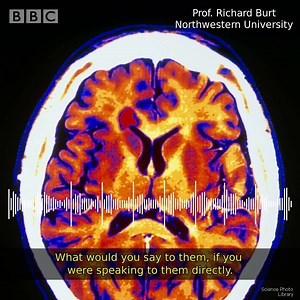 Doctors say a stem cell transplant could be a "game changer" for patients with multiple sclerosis. | BBC World Service