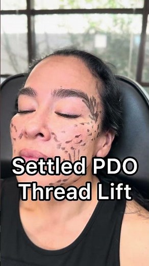 PDO Thread Lift: Your Non-Surgical Facelift Solution! 💫