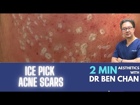 Treating Ice Pick Scars