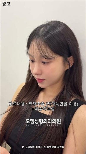 수술후 1개월:자가늑 코재수술+비순각교정