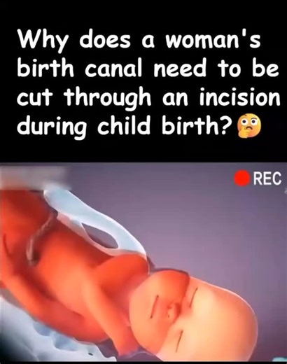 Rx_Vibes on Instagram: "Why a Woman’s Birth Canal May Need to Be Cut During Childbirth (Episiotomy) During childbirth, doctors may perform an episiotomy, which is a small incision made in the perineum (the area between the vagina and anus). It is not done routinely—only when medically needed. An episiotomy may be required when: The baby needs to be delivered quickly (fetal distress) The mother is at high risk of a severe natural tear The baby is very large Complicated deliveries (shoulder dystoc