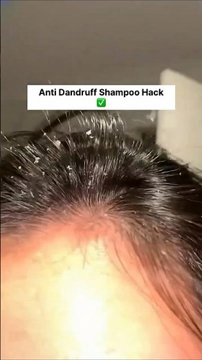 Remove Dandruff In Just 1 Day | Get Rid Of Dandruff 😱 Effective Tips & Tricks #dandruff #haircare