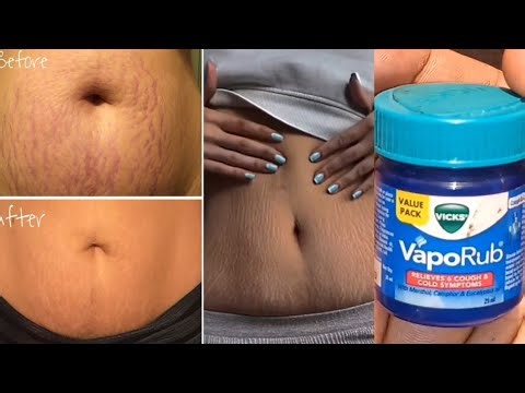 3 Easy Homemde Recipes For Remove Stretch Marks Completely From All Body Parts
