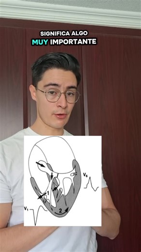 Conviértete en experto del EKG: Bloqueo de Rama Izquierdo