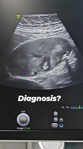 Gall bladder pathology.. #sonographiccasestudy #Radiology #education #ultrasound #fblifestyle #reelsvideo #reelsvideoシ | Sonographic case study
