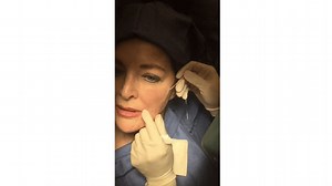 Silhouette InstaLift — See This Facelift Without Surgery