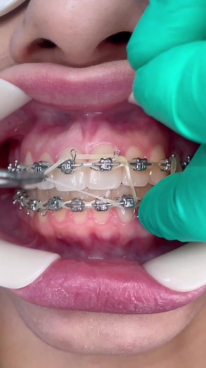 Tips for Wearing Braces Elastics: Rotational Wedge Braces