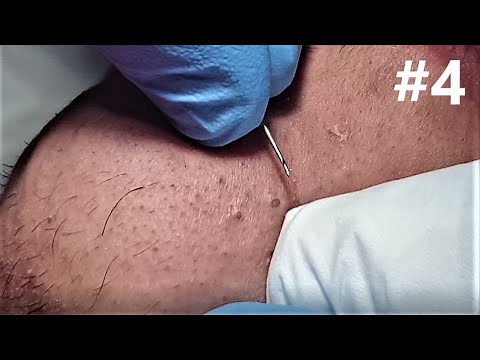BIG BLACKHEADS EXTRACTIONS on Happy :) #4