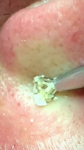 Understanding Inflamed Skin: Nose Care Tips