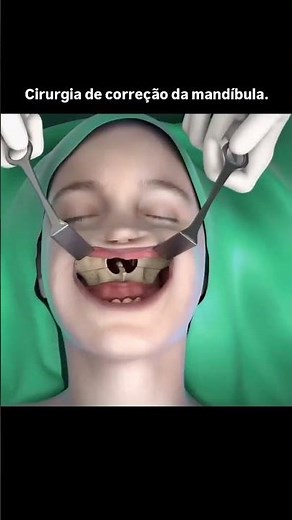 Osteotomia: Como Cirurgiões Remodelam o Maxilar?