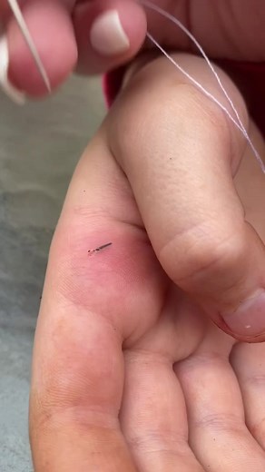 When your daughter is terrified, but asks you to put it on TikTok! 😂 #oddlysatisfying #splinter #splinterremoval #JingleJangleWithMe #momsoftiktok