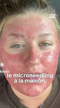 Microneedling : les risques d’une pratique beauté tendance | RTS