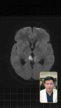 Think every pineal lesion is a pineocytoma or pineoblastoma? Think again. 👀