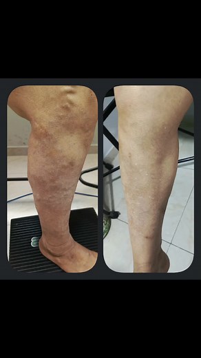 ¿Te molestan las várices y quieres deshacerte de ellas de una manera efectiva y segura? 🌸 PILLARO MIÉRCOLES 26 DE JUNIO🌸 Campaña especial de esclerosis con espuma de polidocanol, un tratamiento innovador y mínimamente invasivo para eliminar esas molestas venas varicosas. 🔹 ¿Qué es la esclerosis con espuma de polidocanol? Es un procedimiento médico que utiliza una solución espumosa de polidocanol para cerrar y eliminar las várices de manera rápida y eficaz. Este tratamiento es ideal para aquel