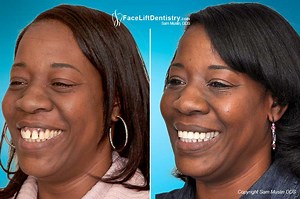 Bite Correction in 8-Days, No Drill, Braces, or Surgery