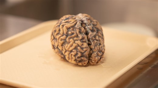 First physical evidence of blast wave injury found in an Australian soldier's brain