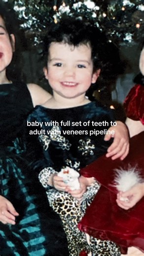 Transforming Smiles: Veneers Journey from Baby Teeth