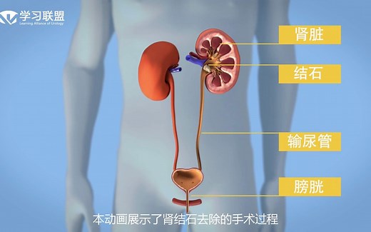 泌尿外科两种常用的微创取石手术（经皮肾镜和输尿管镜取石术，PCNL与URS）