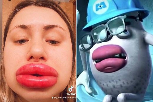 Woman gets 'Monsters Inc' lips following botched operation