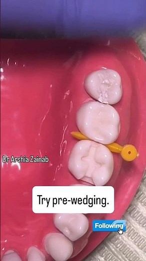 Pre-Wedging for Class II Restorations | Easy Matrix Band Placement in Tight Contacts