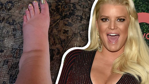 Jessica Simpson's Foot Swells Like a Balloon During Pregnancy